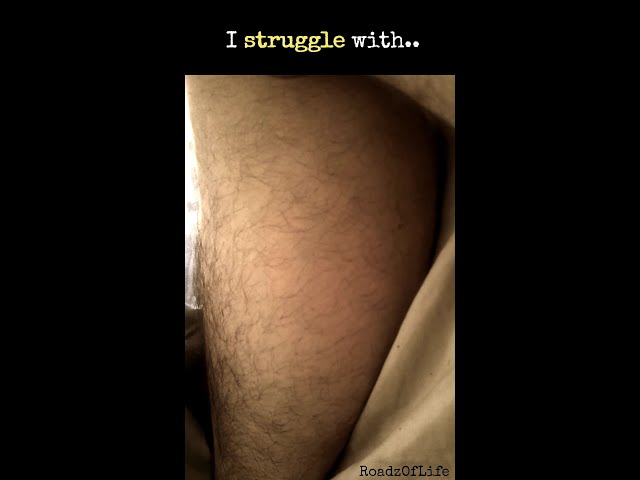 leg spasms | involuntary movements | neurological condition #bizarre #wtfmoments