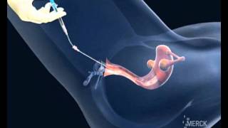 Inseminación artificial