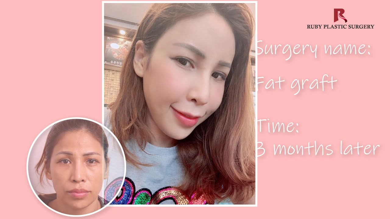 Full face Fat graft by Ruby Plastic Surgery
