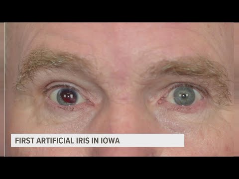 Iowa's first artificial iris implant is pretty amazing