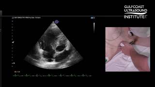 Modified Views to Assess TR and TAPSE