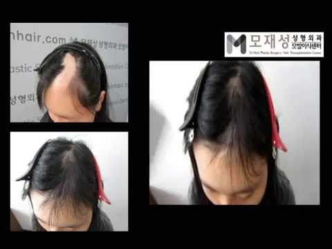 Hair Transplantation on scalp scar