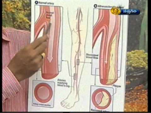 Intermittent claudication Ayurveda Treatment Dr.T.Venugopal Rao M.D - YouTube