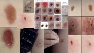 ACV vs. Flat mole 30 mins step by step healing scars comparison Part 1