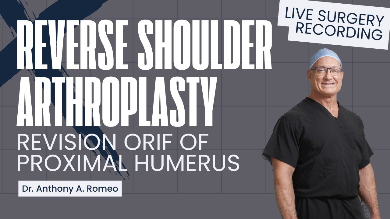 Reverse Shoulder Arthroplasty - Revision of ORIF of Left Proximal Humerus