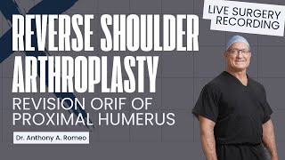 Reverse Shoulder Arthroplasty -  Revision of ORIF of Left Proximal Humerus - Anthony A. Romeo, MD
