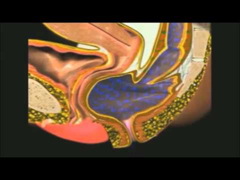 STARR Surgery for Constipation Video by Healing Hands Clinic, Pun