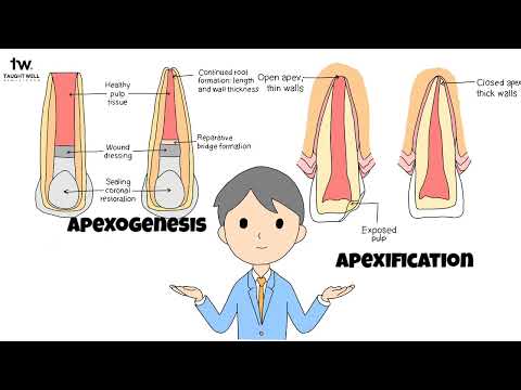 Apexogenesis and Apexification: Mastering Endodontic Procedures as a Dental Student