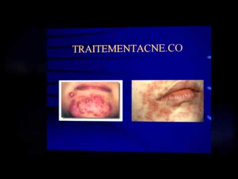 comment traiter acné