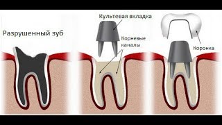 О стоматологии , ответы на вопросы , культевая вкладка , имплантация , штифты