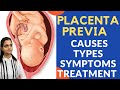 Placenta Previa क्या होता है | Placenta Previa के लक्षण और इलाज | Dr. Mayu