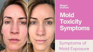 Mold Toxicity Symptoms| The Symptoms of Mold Exposure