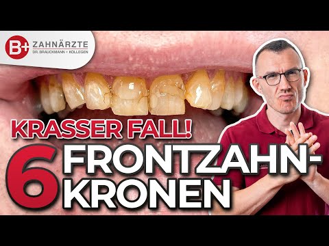 I don't want crowns on my front teeth! Therefore, you have nothing to fear! Patient case: upper jaw