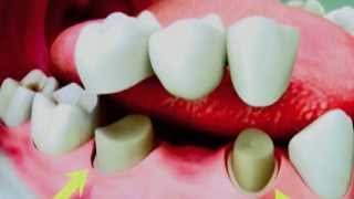 preview picture of video 'Dental Bridges - How to properly clean your teeth'