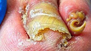 The Ingrown Nails Are Curled Like Horns! Professional Pedicure【Xue Yidao】