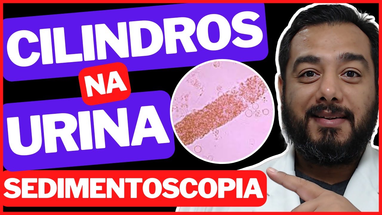 O que significa presença de cilindro na urina? | Sedimentoscopia | Exame de urina tipo 1 | EAS