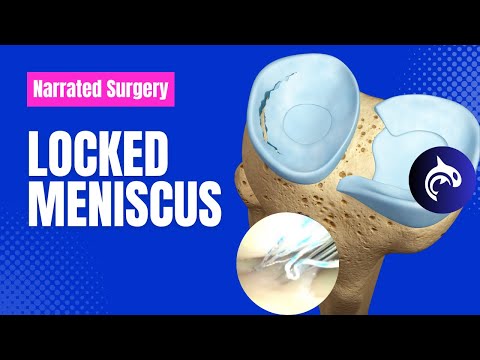 Patellar Dislocation 3D Animation Live Surgery