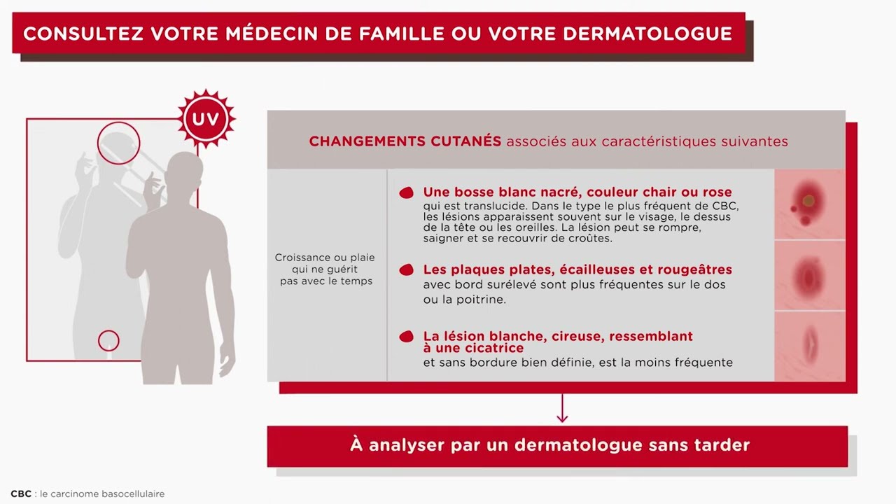 Mieux Comprendre le Carcinome Basocellulaire (CBC)