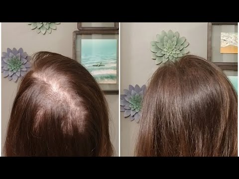 How to deal with that crazy part in the back of your head?