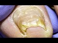 Wow ~ Crazy ingrown nails, leaking a lot of pus【Doctor Liu Pedicure】