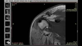 6-Rhabdomyolysis