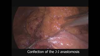 Cirugia Bariatrica y Hernia Ventral operado de forma simultanea por Laparoscopia