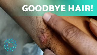 How to REMOVE an Ingrown HAIR From the ARMPIT 🤔 (Underarm Ingrown Hair Removal)