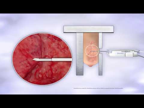 Brevera Breast Biopsy System - Animation