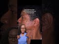 Causes Of Brown Bumps On The Face Dermatosis Papulosa Nigra DPN And Treatment