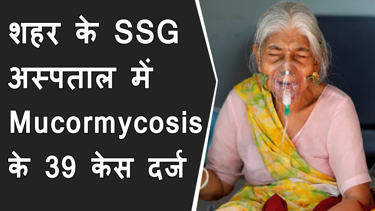 शहर के SSG अस्पताल में Mucormycosis के 39 केस दर्ज | New 39 case of Mucormycosis in vadodara