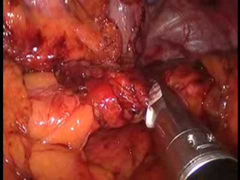 Distal Pancreatectomy - Laparoscopy