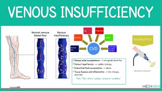Venous Insufficiency Explained | High-Yield Nursing & Medical Lecture for NCLEX & USMLE