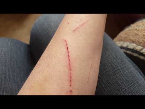 First Aid for Cat Scratches