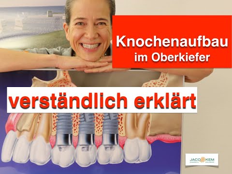 Zahnimplantate im Oberkiefer: Sinuslift - so gehts wirklich