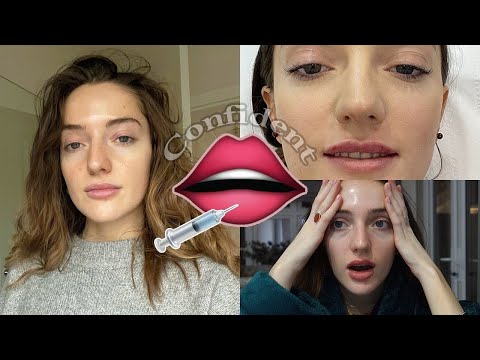 first time lip filler 1ml Therapie Clinic BLUEWATER