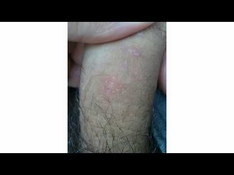 Pidal burning ay isang fungus o hindi Langis kapag ang kuko halamang-singaw