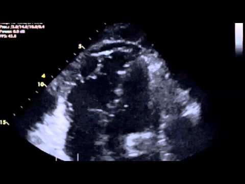 Fat Embolism Syndrome