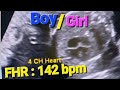 heartbeat ultrasound sound | heart rate boy/girl | Fetal doppler heartbeat sound | fetal heart rate