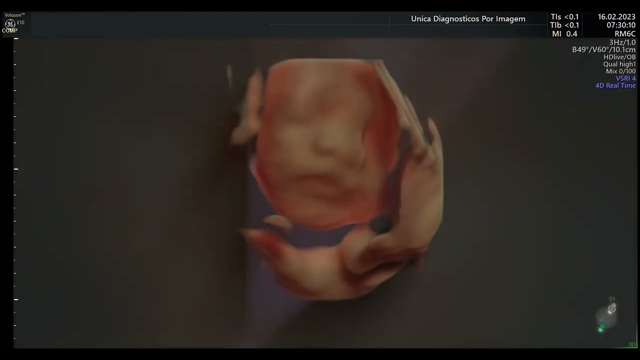 Ultrassom 4D HD LIVE ou Ultrassom 5D - 4