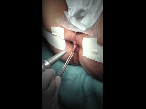 Prostata-Operation Preise Reise Die Wirkung auf Prostatitis Abstinenz