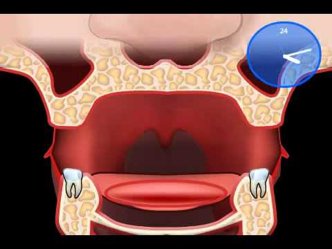 wieso wackelt die Zahnprothese - der Schlotterkamm