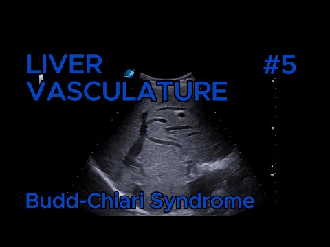 Budd-Chiari syndrome - Intrahepatic collateral veins video preview