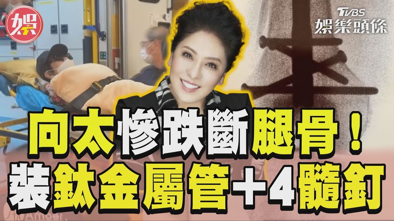 影音／向太浴室慘跌斷腿骨！　大腿釘鈦金屬管+4髓釘