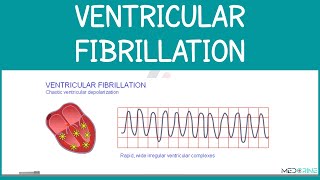 Ventricular Fibrillation (VFib) Explained | ECG Interpretation for Medical & Nursing Students
