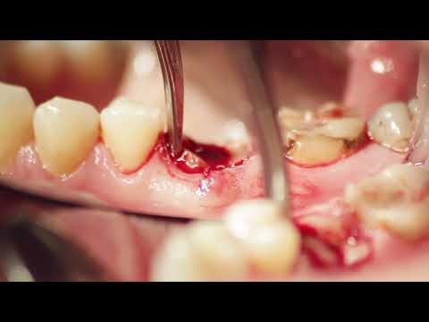 Cum folosesti instrumentarul LIFTOUT C4 LM Dental