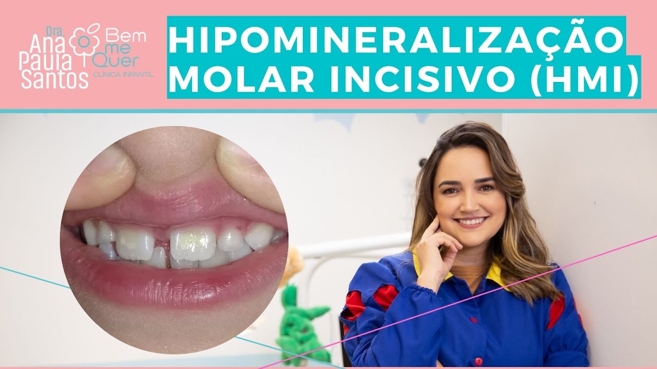 HIPOMINERALIZAÇÃO MOLAR INCISIVO | Dra. Ana Paula - Odontopediatra