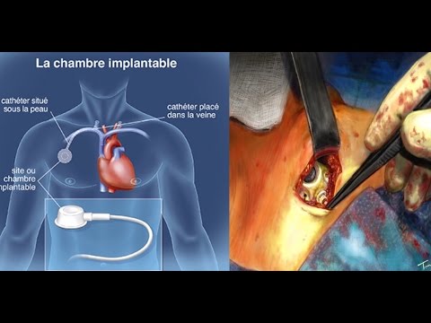 Complication phlébite Complication phlébite