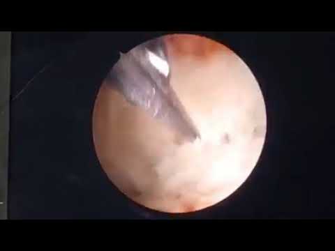 Hysteroscopic Septal Resection