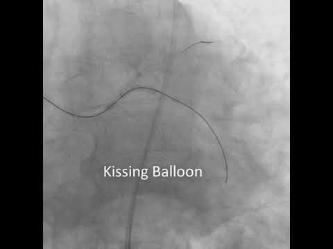 LMCA Distal Bifurcation Culotte Stenting- Ertan Yetkin