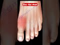 Big Toe Pain